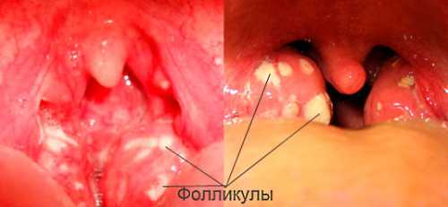 орви: симптомы и течение самого распространённого в мире заболевания