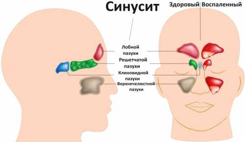 синусит у детей: симптомы, причины и лечение